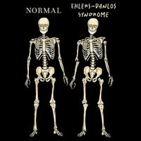 Ehlers Danlos Syndrome Skeletons Zebra Awareness Backpack