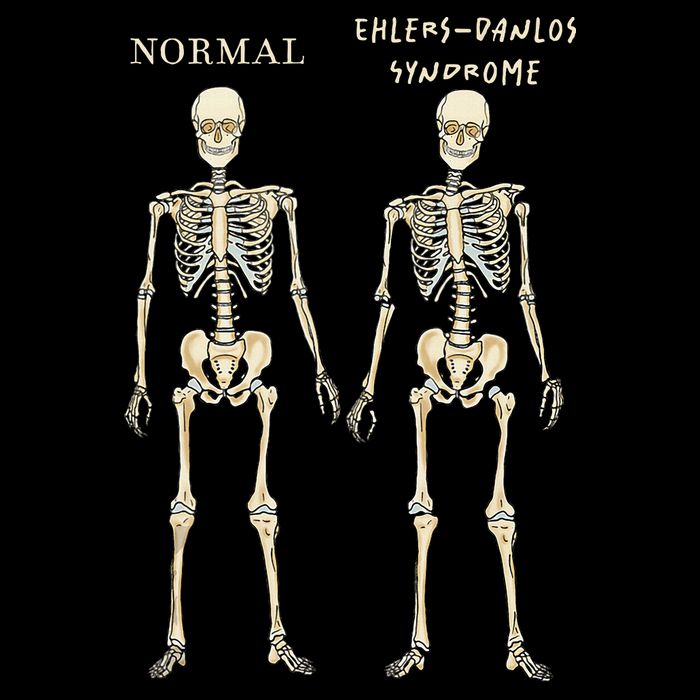 Ehlers Danlos Syndrome Skeletons Zebra Awareness Backpack