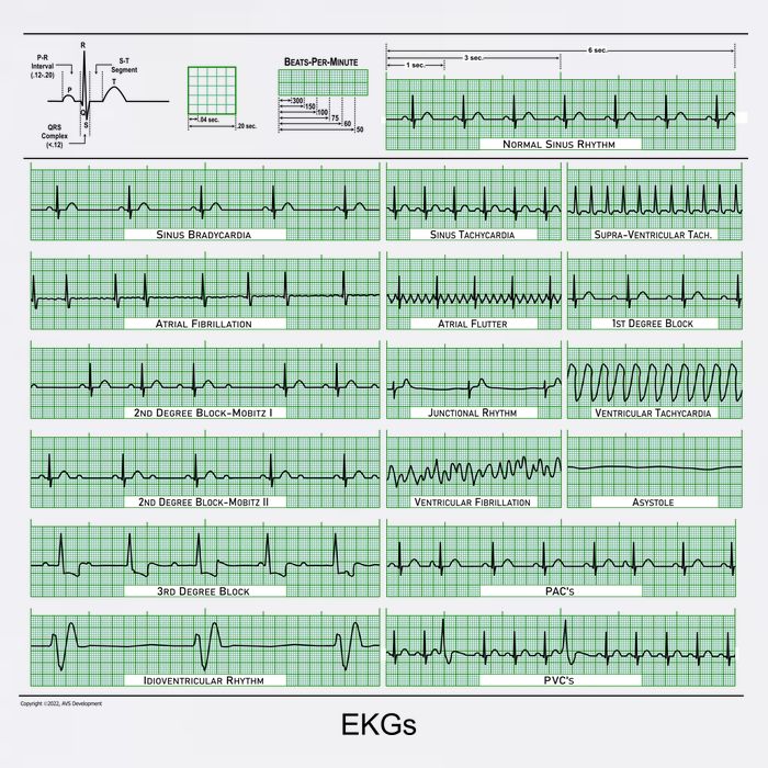EKG Training Mug 11oz C Handle Ceramic Mug